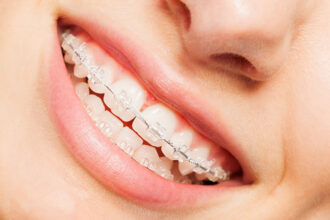 ceramic clear braces