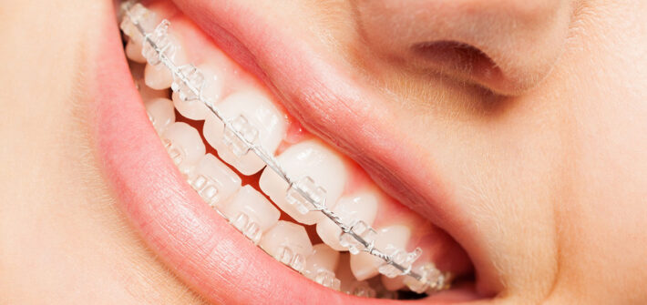 ceramic clear braces